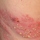 Illustration for article titled Bagaimana Mengobati Penyakit Herpes